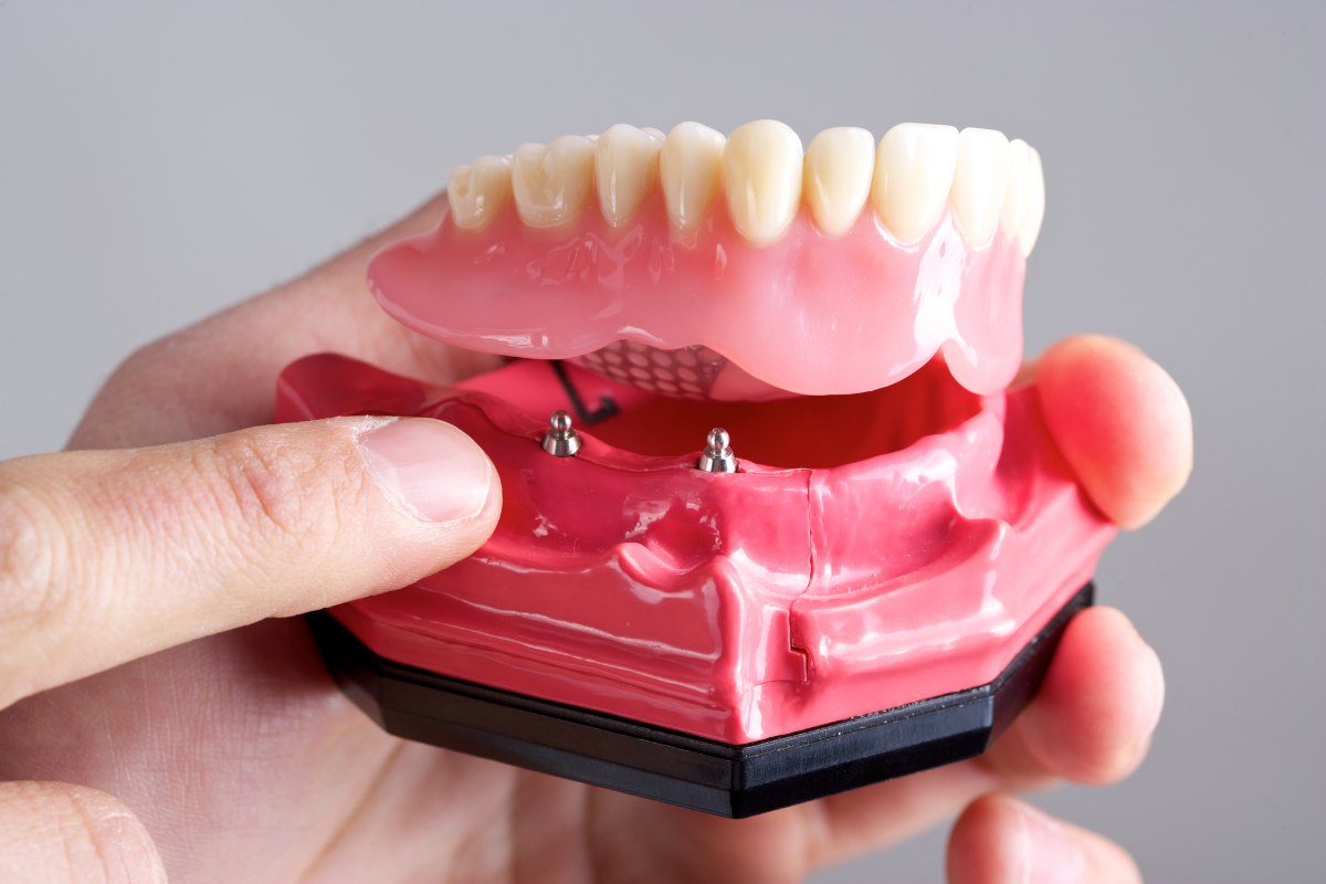 Dental İmplant Bakımı: Sağlıklı Bir Gülüş İçin İpuçları