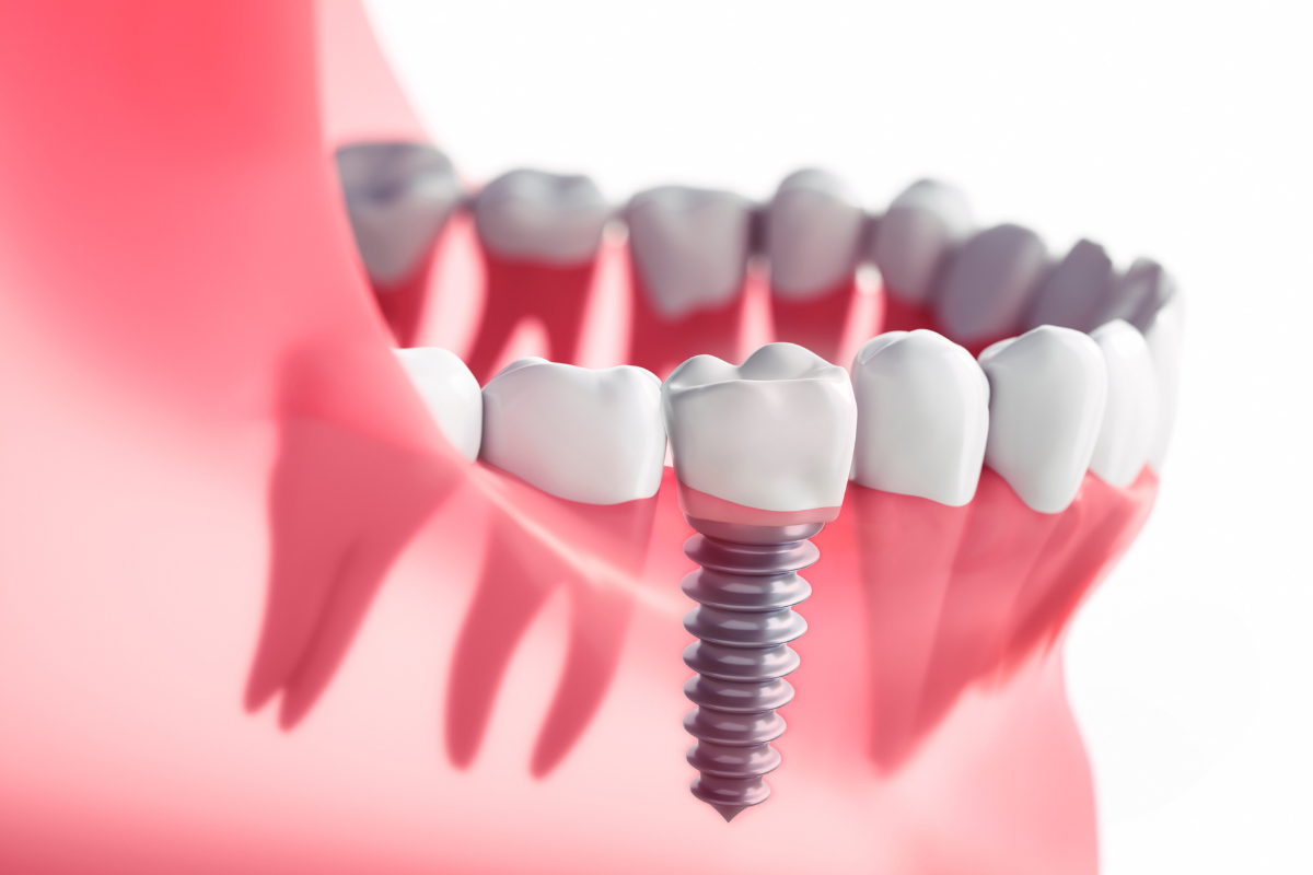 Dental İmplant ve Alternatif Tedavi Yöntemleri